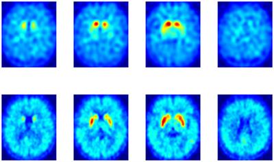 Multivariate Analysis of 18F-DMFP PET Data to Assist the Diagnosis of Parkinsonism